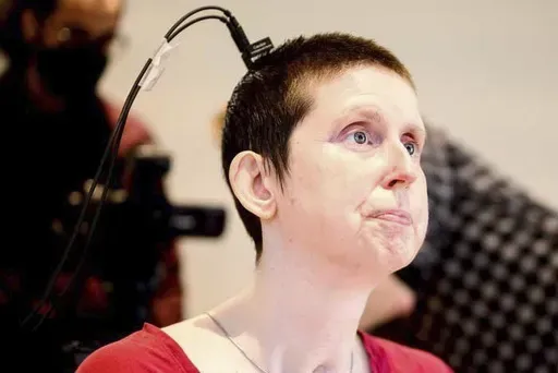 This photo provided by researchers at UCSF and UC Berkeley shows Ann, a participant in a study on speech neuroprostheses, in California in 2023. (Noah Berger/UCSF, UC Berkeley via AP)