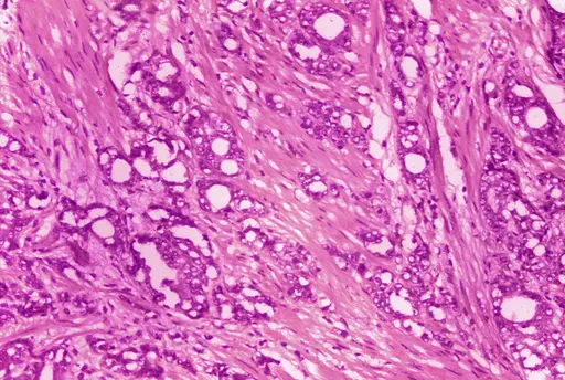This 1974 microscope image made available by the Centers for Disease Control and Prevention shows changes in cells indicative of adenocarcinoma of the prostate. A study published by the New England Journal of Medicine on Saturday, March 11, 2023, finds long-term evidence that actively monitoring prostate cancer can be a safe alternative to immediate surgery or radiation. (Dr. Edwin P. Ewing, Jr./CDC via AP)