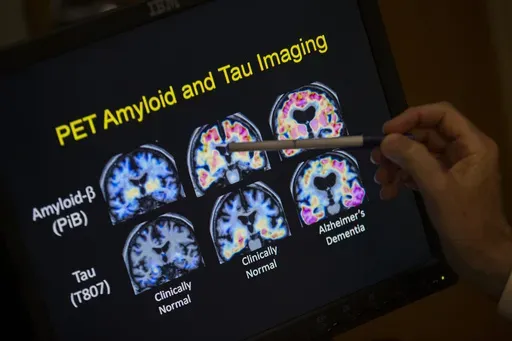 A doctor points to PET scan results that are part of a study on Alzheimer's disease at Georgetown University Hospital, on Tuesday, May 19, 2015, in Washington. (AP Photo/Evan Vucci, File)