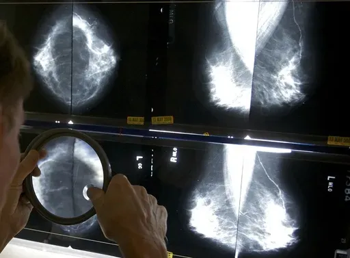 A radiologist uses a magnifying glass to check mammograms for breast cancer in Los Angeles, May 6, 2010. (AP Photo/Damian Dovarganes, File)