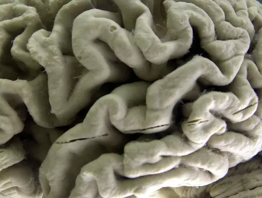 A closeup of a human brain affected by Alzheimer's disease, is displayed at the Museum of Neuroanatomy at the University at Buffalo in Buffalo, N.Y., on Oct. 7, 2003. According to findings published Wednesday, Feb. 21, 2024 in the New England Journal of Medicine, Alzheimer’s quietly ravages the brain long before symptoms appear and now scientists are getting a closer look at the domino-like sequence of those changes _ a potential window to one day intervene. (AP Photo/David Duprey)
