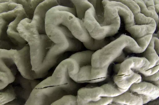 A section of a human brain with Alzheimer's disease is displayed at the Museum of Neuroanatomy at the University at Buffalo, in Buffalo, N.Y., Oct. 7, 2003. A long-feared gene appears to do more than raise people’s risk of Alzheimer’s: Inheriting two copies can cause the mind-robbing disease, according to research published in the journal Nature Medicine on Monday, May 6, 2024. (AP Photo/David Duprey, File)